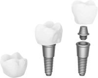 Dental implant PNG