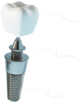 Dental implant PNG
