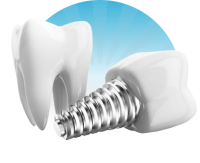 Dental implant PNG