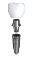 Dental implant PNG