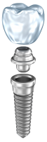 Dental implant PNG