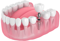 Dental implant PNG